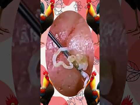 Blackheads Removal | Acne Treatment and Very Satisfying Satisfying Pimple pop #blackheads