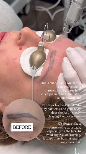 PMU Tattoo Removal Progress ✨ This is our second PMU tattoo removal...