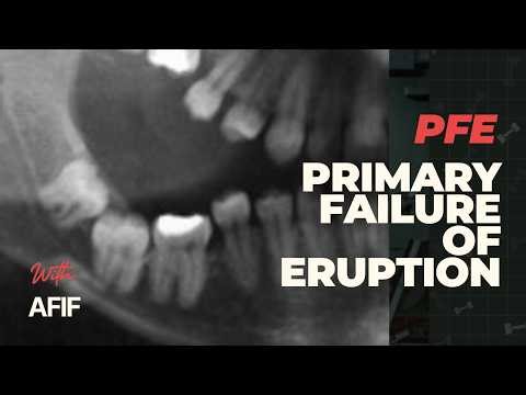 Podcast: Primary Failure of Eruption PFE
