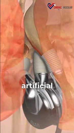 World’s First BiVACOR Total Artificial Heart Implant at Baylor St. Luke’s Medical Center 🫀🤖