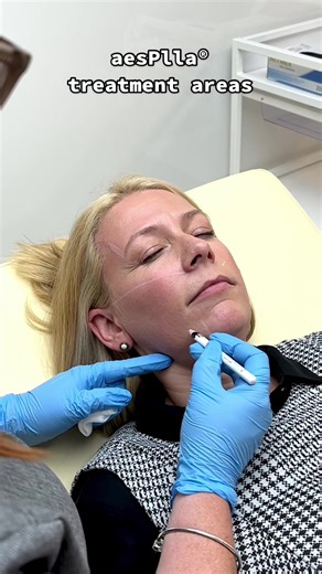 aesPlla® treatment areas 🤩 Let us know your favourite in the comments ⚡️#aesplla #plla #pllafiller
