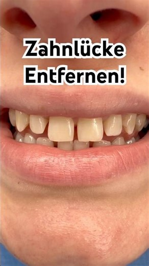 Zahnlücken einfach entfernen - Flowable Injection Technique #flowableinjection #schönezähne #veneer