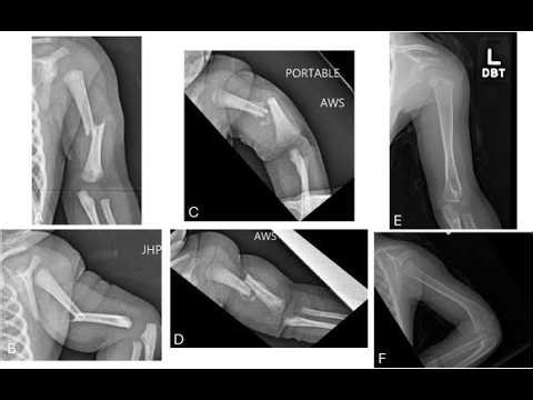 Birth Injuries; Clavicle fracture, Humerus fracture, femur fracture, Depressed skull fracture birth