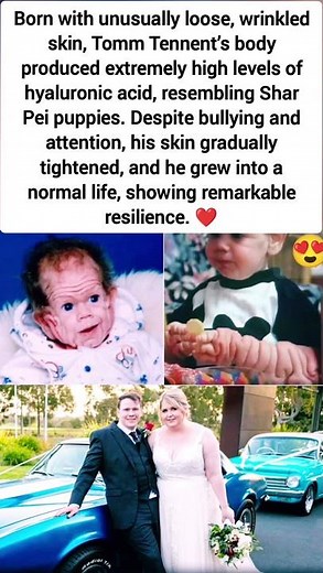 The Boy Born with Wrinkled Skin: Tomm Tennent’s Remarkable Journey #viral #story #humanity #facts