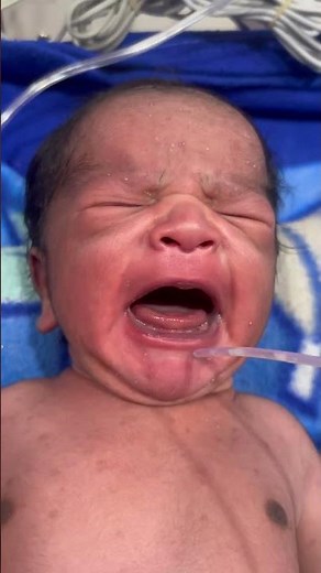 Newborn Baby NG Tube Removal Procedure in NICU #NewbornBaby #NGTubeRemoval #BabyHealth #TubeRemoval