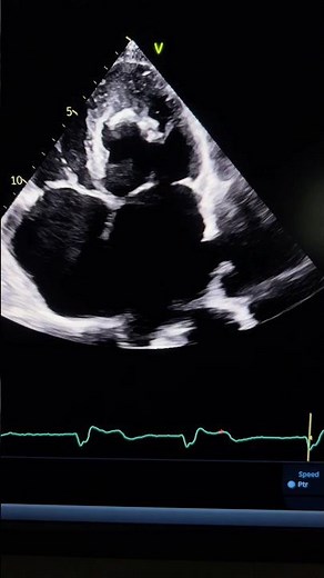 Apical obliteration 😨 What’s the diagnosis ? See the description👇 #echocardiography #cardiacimage