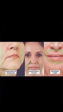 how to remove smile lines from face naturally♨️