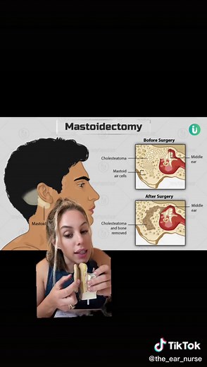 A #mastoidectomy is necessary when an #earinfection (#otitismedia) spreads to your skull. The procedure is also used to treat #cholesteatoma — a #noncancerous growth that forms behind your #eardrum, often as a complication of #chronic ear infections. #theearnurse #earwaxremoval #doctorearwax #earproblems #nursesoftiktok #fyp #health