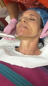 Neck Microneedling