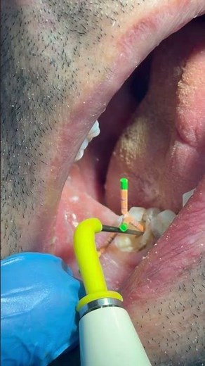 Root Canal Detail | Gutta-Percha Trimming Close-Up (Silent)