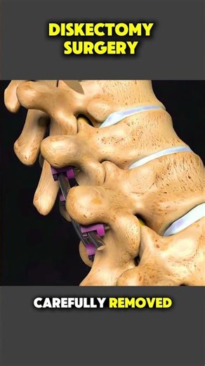 How Discectomy Surgery Is Done | Step-by-Step Spine Surgery #Discectomy #SpineSurgery #backpain
