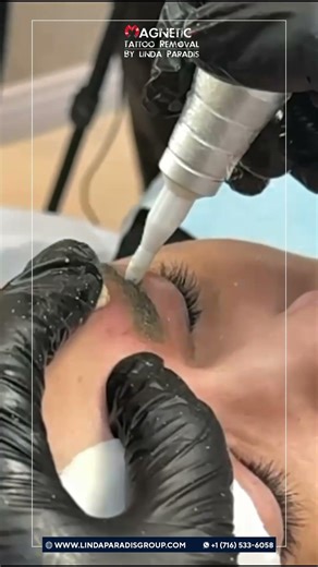 Magnetic Tattoo Removal in Slow Motion | How Pigment Is Extracted