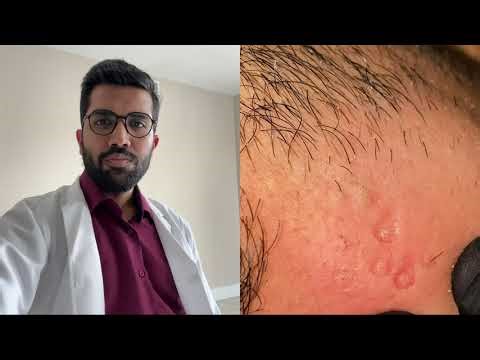 🥴Multiple big comedones #blackheadremoval #pimplepopping