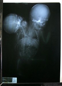 Baby Born With 2 Heads, 3 Hands In Rare Conjoined Twin Case Fighting For Life