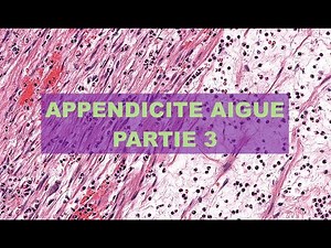 APPENDICITE AIGUE (partie 3) - PATHOLOGIE