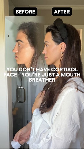 Helen Leland | Posture, Health & Beauty Educator on Instagram: "Comment “TAPE” and I’ll send you a discount on my favorite non-toxic mouth tape (trust me - I’ve tried every mouth tape brand out there)!! “Cortisol face” seems like THE buzzword lately. But really - you may just be a mouth breather. Ever notice how much mouth breathing affects your face? For 28 years — I was a mouth breather too!! Just look at that before 😅 when I started mouth taping is when everything changed. No more tir