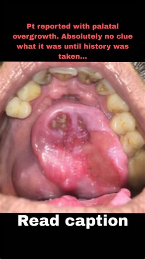 Dr.Vinayak Thorat- Dental Education on Instagram: "A 54-year-old male 👨 presented with a slow-growing swelling on the palate 🦷. The lesion started small (pea-sized) and gradually increased in size over time ⏳. Interestingly, the patient had a previous history of nasal rhinosporidiosis surgery 👃 — a key clue in solving this case! 🔍 What was seen clinically? • Painless palatal mass 😶 • Gradual enlargement 📈 • Reddish / polypoid appearance 🔴 • Suspicion of recurrence ♻️ Rhinosporidiosis lesi
