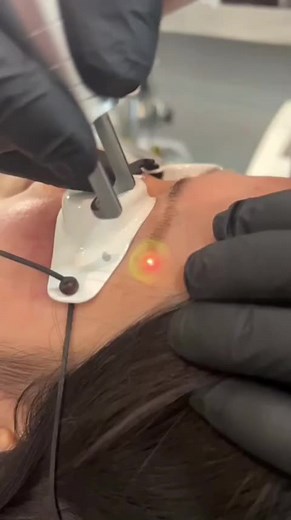 Remoção de Maquiagem definitiva da sobrancelha com laser Spectra XT #pmu #tattoo #foryou #micropigmentação