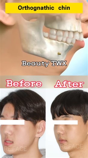 Mr.Davide on Instagram: "Comparison of pre - and post-operative effects of orthognathic surgery! #plastic #整形 #医美 #glowup #things #medicalbeauty #facelift"