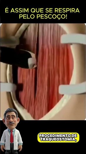 Como é feita uma TRAQUEOSTOMIA? 😱