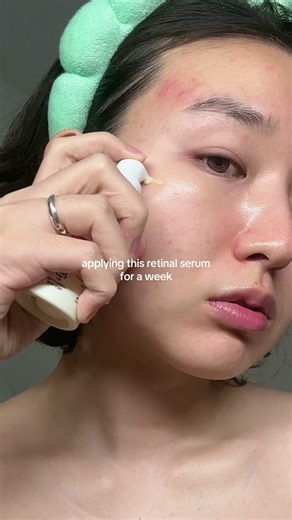 Retinal for Acne-Prone Skin: Effective Skincare Guide