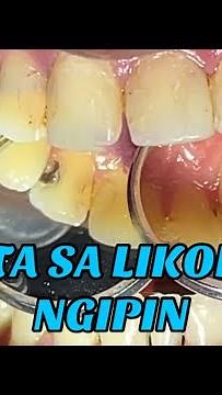 Pasta sa likod ng Ngipin (Tooth filling)