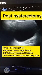 Post Hysterectomy ultrasound #ultrasound #uterus #pelvic #shorts#infertility