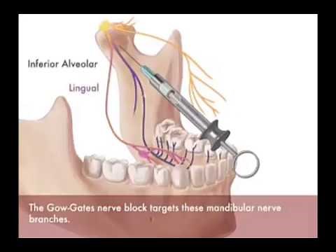 gow gates nerve block