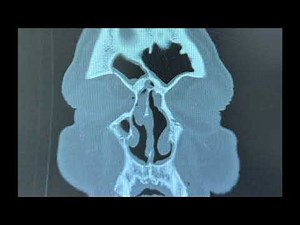 Bilateral endoscopic sinus surgery for sinusitis with polyposis