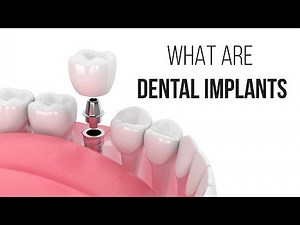 All you need to know about dental implant procedure