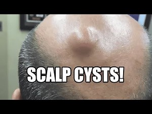 Pilar Cysts! What's Inside, Symptoms and Treatment!