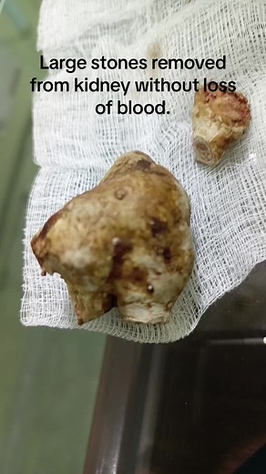 Stone Removal Procedure Without Blood Loss - Urologist in Sheikhupura