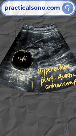 Simple Renal Cyst Ultrasound Features #ultrasonography #ultrasoundtraining