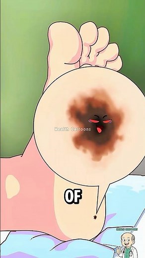 When a Normal Mole Turns Dangerous #shorts