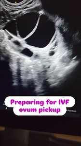 8.6K views · 39 reactions | IVF process procedure success hope real case scenario! 爛 #IVF #success #hope #realcase | Dr Shivani Mishra Hardoi official | Facebook