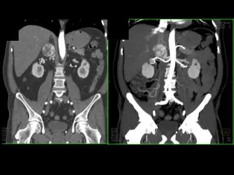 CT of the Adrenal Gland: A Pattern Approach Part 3