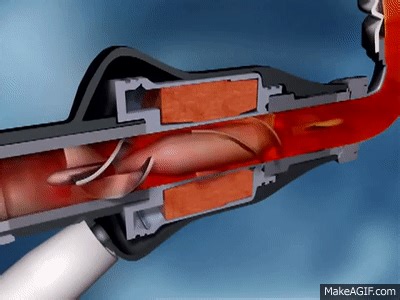 HeartMate II™ LVAD - Funktion on Make a GIF