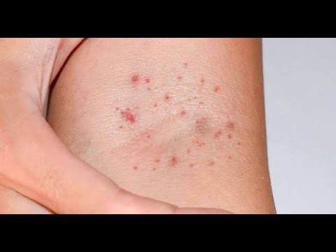Petechiae; small, pinpoint, round spots, appear on skin, mucous membranes