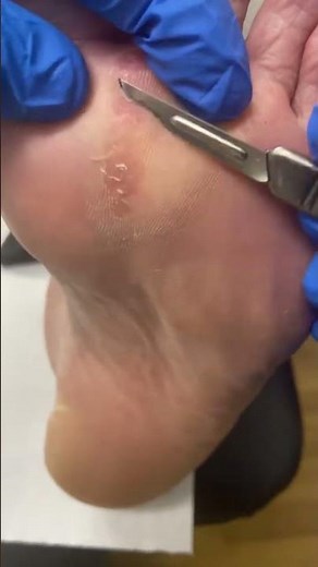 Discover relief in our latest Forefoot Hard Corn Removal video with our Australian podiatrist #FootC