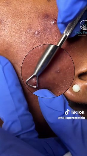 Pustules are inflamed acne lesions filled with pus, resulting from clogged pores and bacterial growth. While professional extraction can help reduce inflammation and prevent scarring, it’s important to avoid attempting extractions at home, as improper handling can lead to further irritation or infection. #acnejourney #skincare #acnetips #clearskin #creatorsearchinsights #extractions #pustules