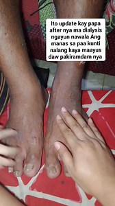 Ito update kay papa after nya ma dialysis ngayun nawala Ang manas sa paa kunti nalang kaya maayus daw pakiramdam nya #ThankYouLord #ThankYouLordForAllTheBlessings #GodBless #fbreels #reelstrending #AngelaFungo #reelsfb #trendingreelsvideo #dialysiswarrior #reels #myday #StarsEverywhere #viral | Angela Fungo