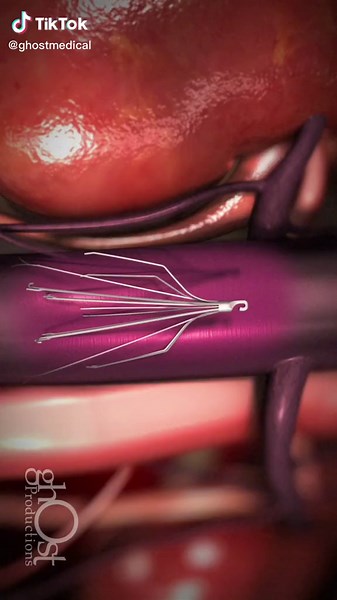 Ghost Productions Inc. (@ghostmedical) - One of our earlier animations featuring the implantation and redeployment of the Bard IVC Filter using access through the jugular vein. #medicaltiktok #vascular #awareness #surgicalprocedure #process