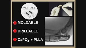 Comminuted Fractures of Olecranon
