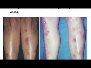 Erythema Nodosum | Causes, Symptoms & Treatment in Dermatology