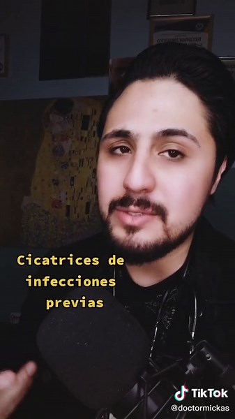 Descubre las Criptas y su Relación con Amígdalas Gigantes
