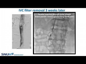 2023 IVC filter removal case Loop snare technique