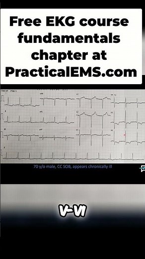 Understanding LVH: Diagnosis and Strain Patterns Explained