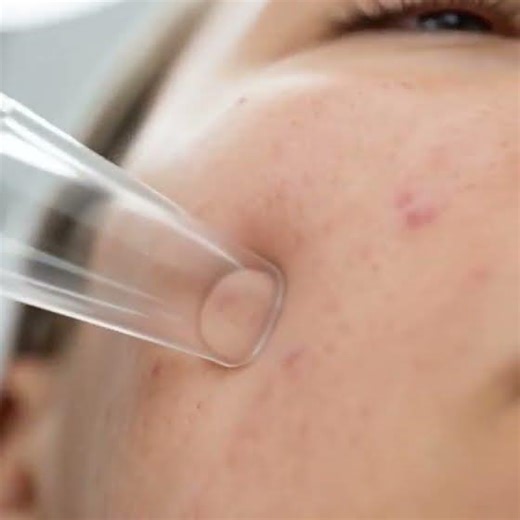 Professional Deep Pore Cleansing & Acne Extraction | Clinical Skincare