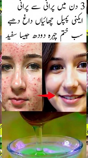 How To Remove Pimples Overnight | Acne Treatment #shorts #shortsvideo #shortsfeed