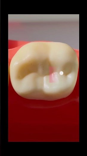 Mastering the mandibular access | Dr.Dentique-hub